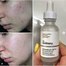 Niacinamide 10% + Zinc 1% Serum 30ml – Oil Control & Pore Refining - Smartify Zone